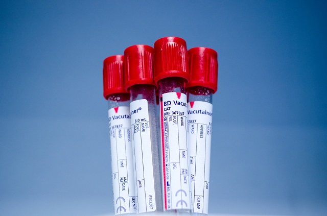 What is HLA-B27 Blood Test?